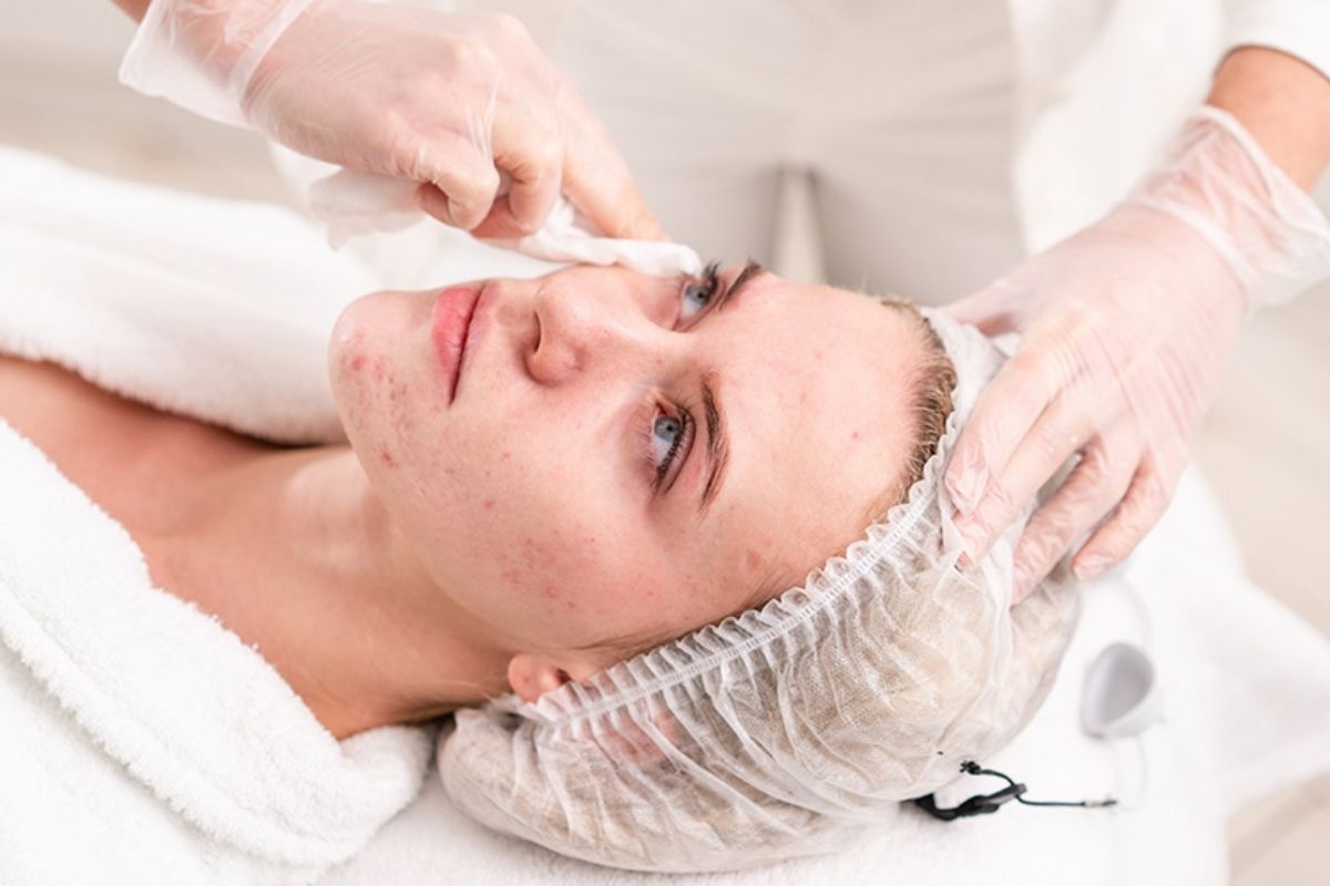2. Why Acne Facial Treatments Beat DIY Fixes Every Time