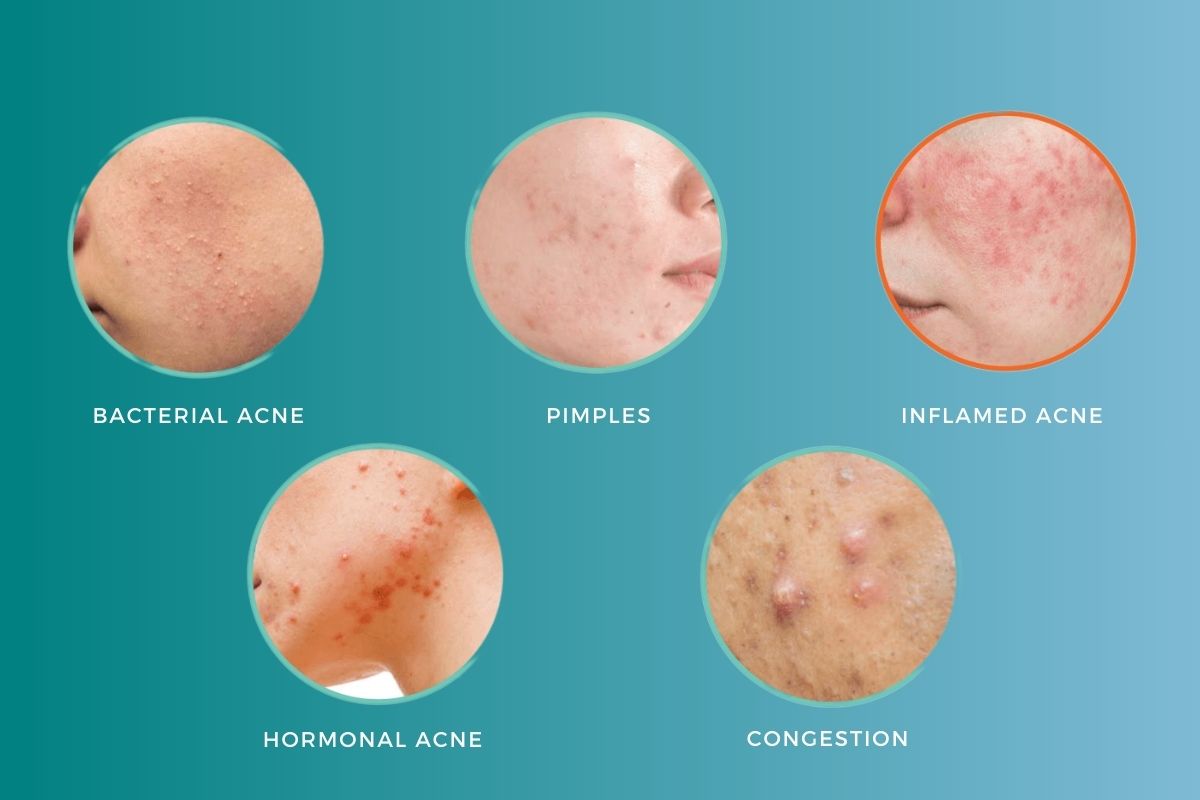 3. Types of Acne We Treat (And Why Customization Matters)