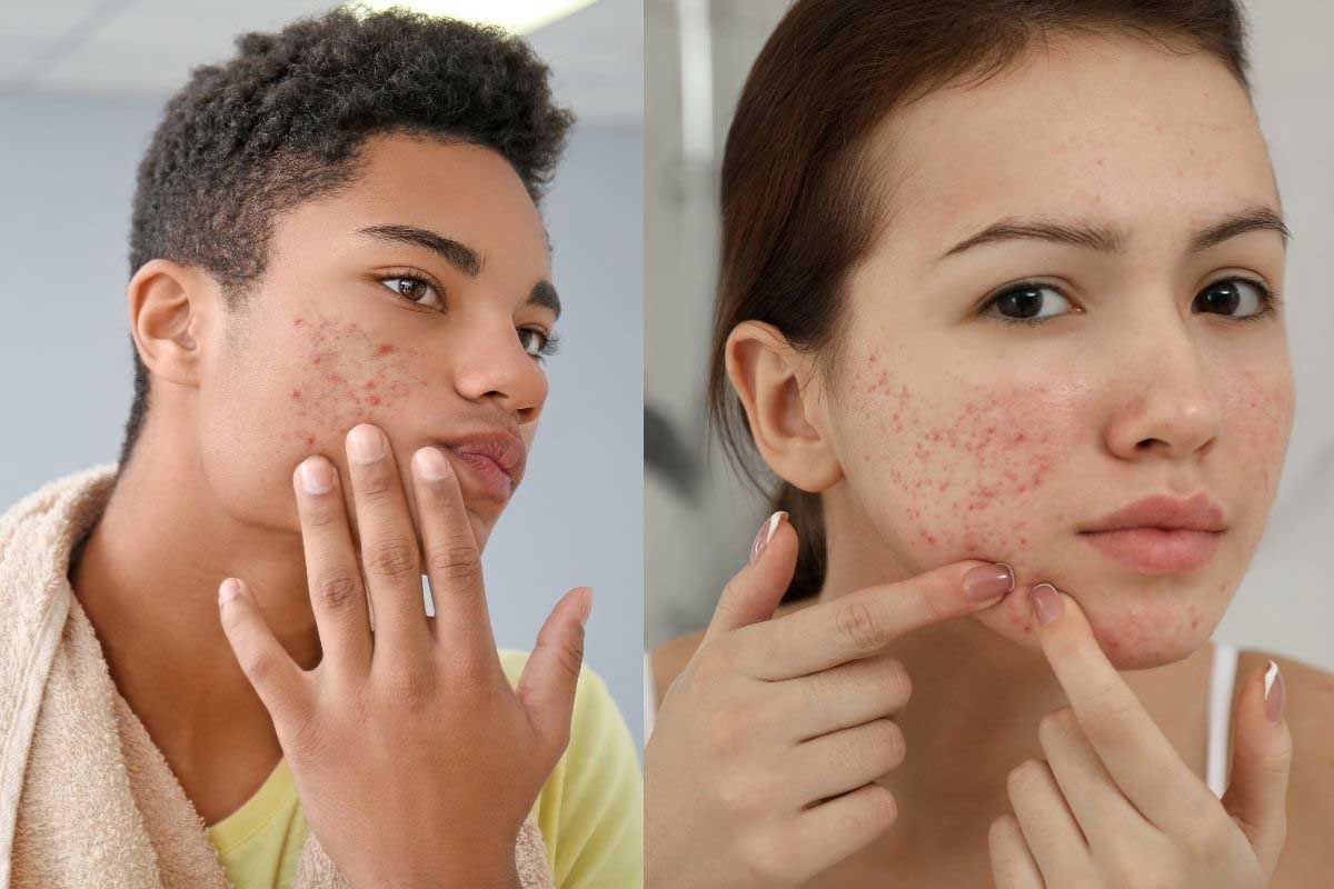 Why Adult Acne Is Different From Teen Acne