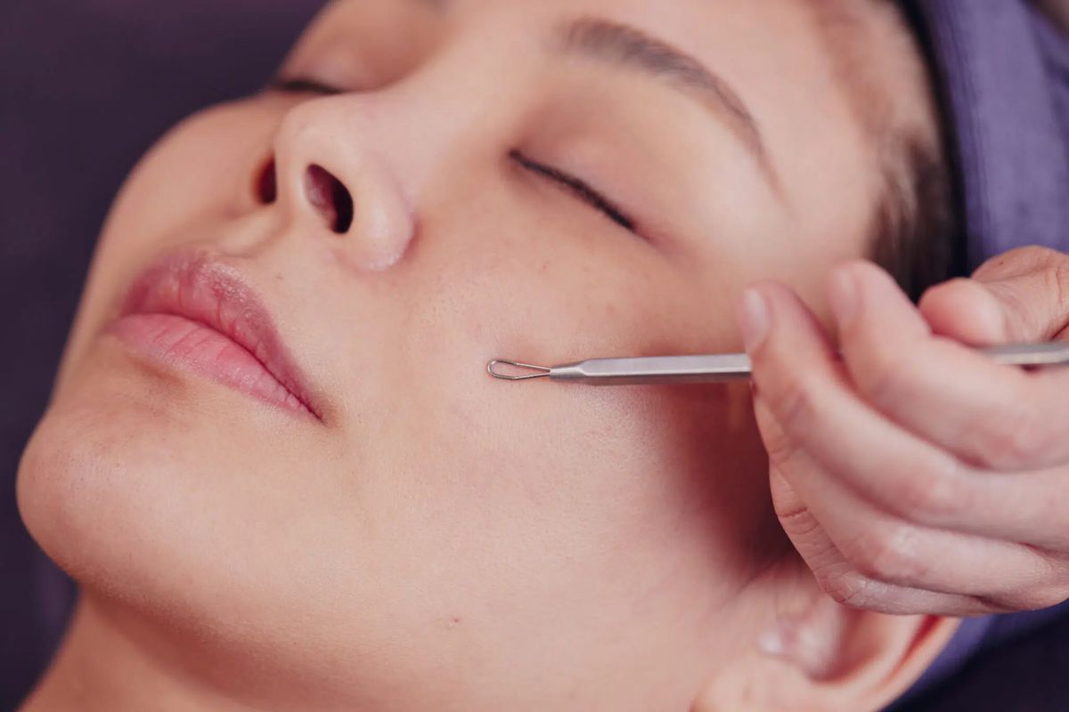 What Professional Adult Acne Treatment in Leawood Actually Looks Like