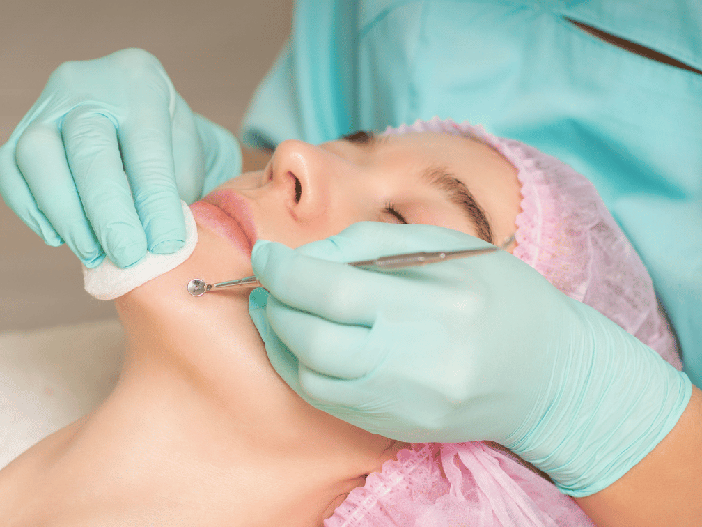 Professional extractions during acne treatment in Leawood KS to remove clogged pores and blackheads