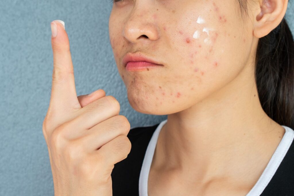Adult Acne in Your 20s, 30s, and 40s: What’s Actually Causing It?